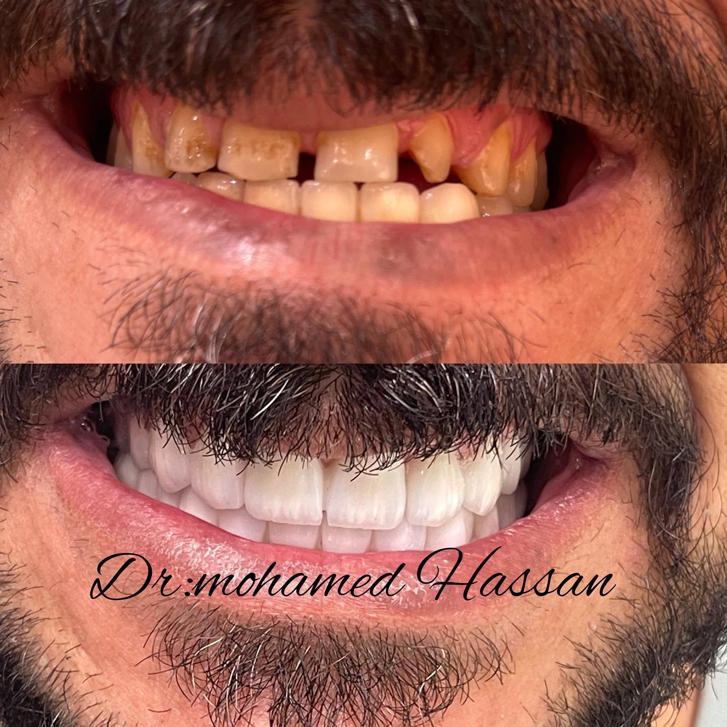 أفضل أنواع زرعات الأسنان في مصر
